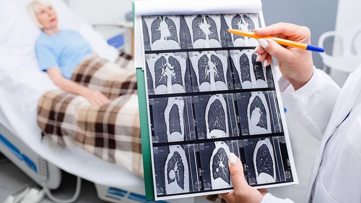 "İnanılmaz bir acı çekiyordum... Doktor bunun emzirmekten kaynaklanan bir rahatsızlık olduğunu söyledi.": Gini, sigara içmeyen ve omuzundaki ağrı nedeniyle acı çeken biriydi. Sonunda akciğer kanseri olduğunu keşfetti. Şimdi, uzmanımız hastalığın gizli ...