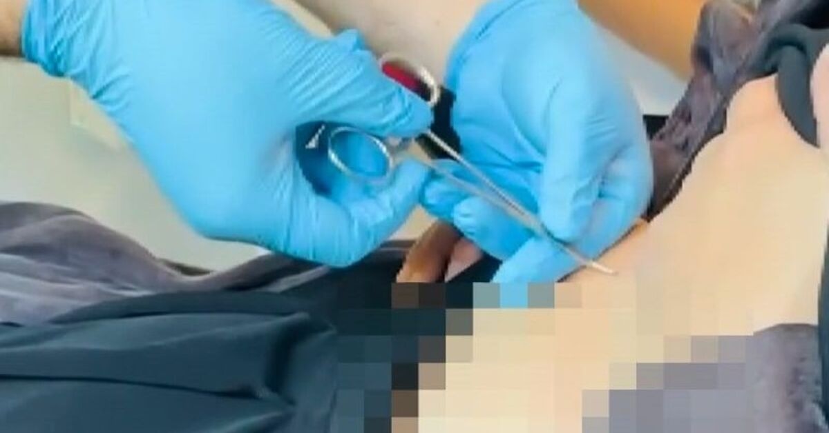 Он пошёл в больницу с жалобами на слабость! Из его живота вылез клещ