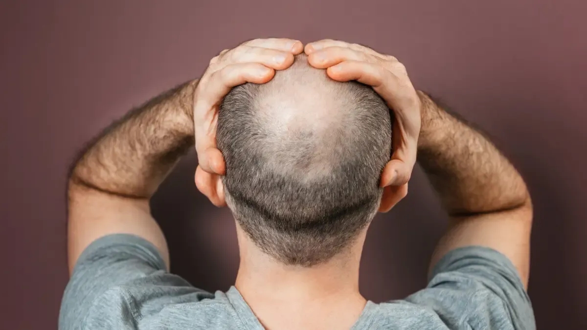 Biofibra, das nicht-chirurgische Haarimplantat, das in Kolumbien angekommen ist