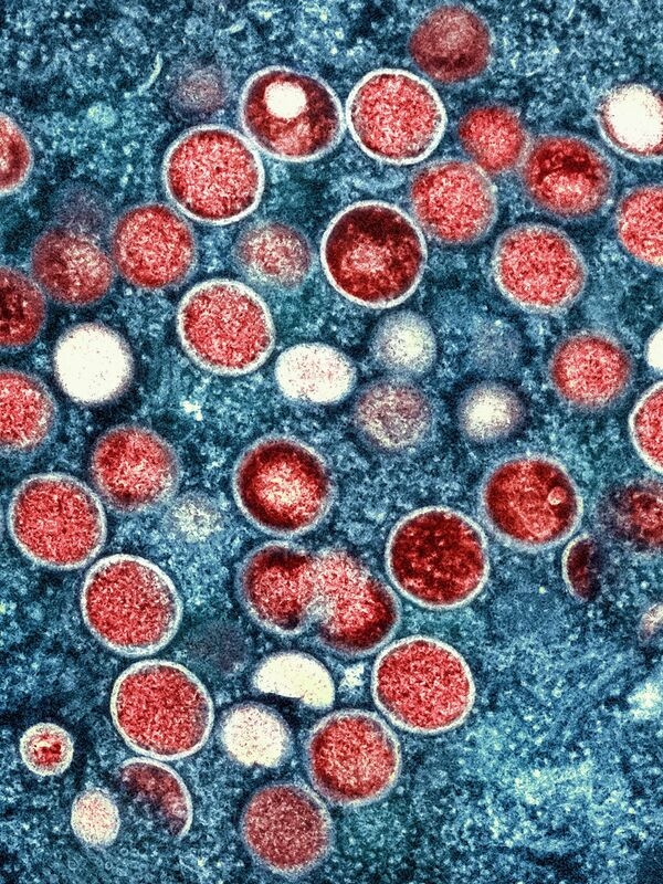 Mpox wird vor allem bei Sex unter Männern übertragen.