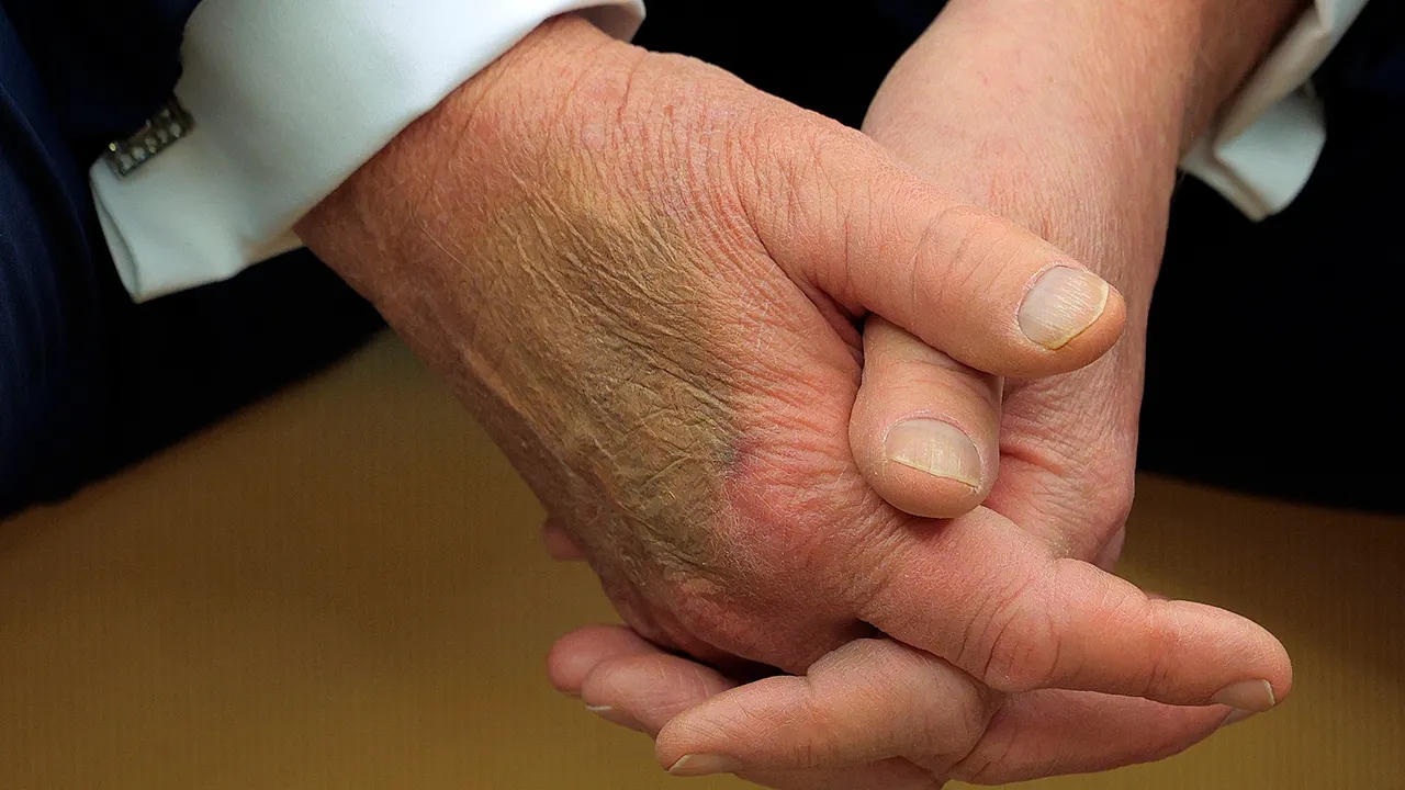 Weißes Haus erklärt blauen Fleck an Trumps Hand, der bei Treffen mit Macron entdeckt wurde