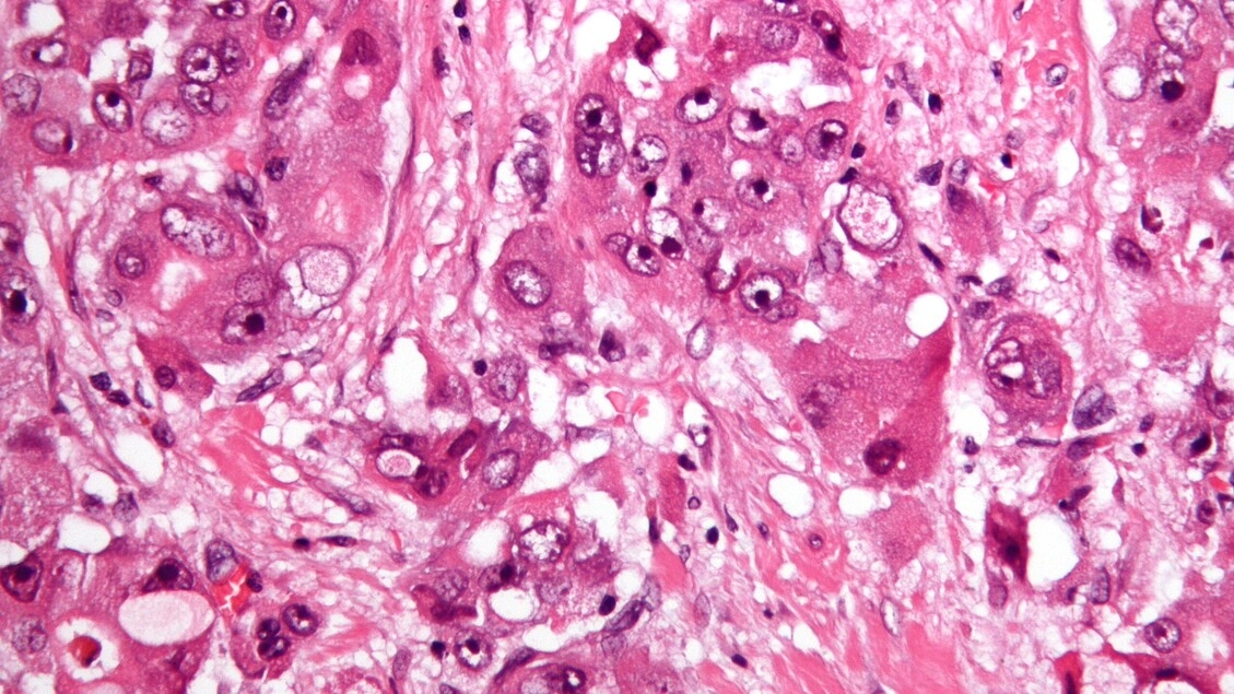Liver cancer cells remodel to resist drugs
