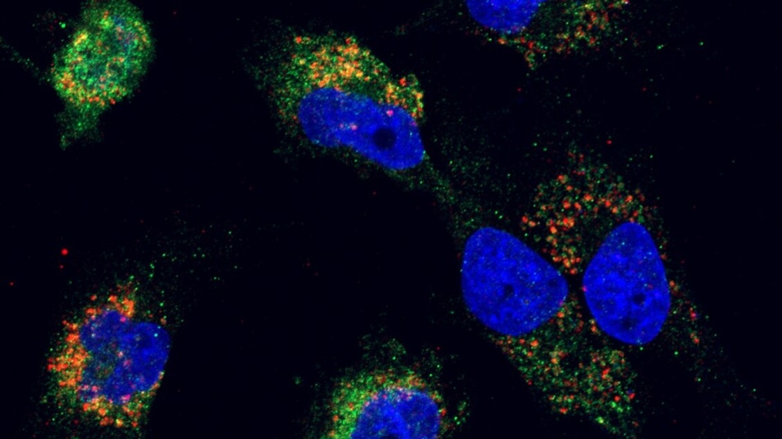 Más de 100 identikits moleculares de tumores cerebrales