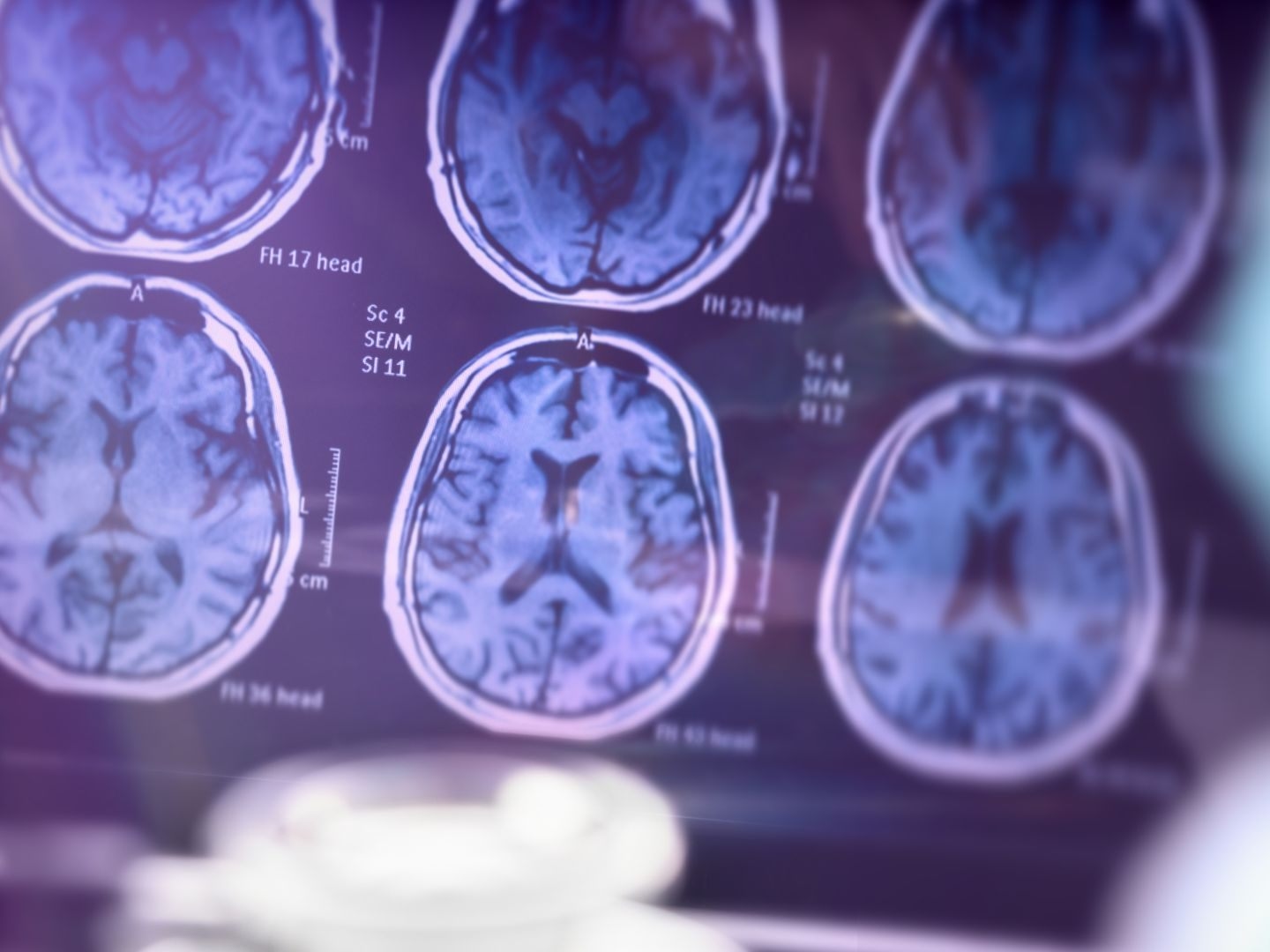 La paura del morbo di Alzheimer diminuisce, nonostante l'aumento dei casi