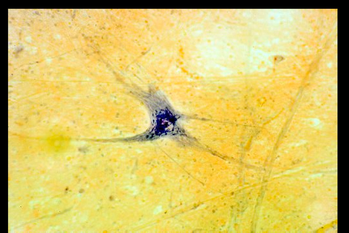 Brain cells in people with schizophrenia were found to be smaller than those of normal people.